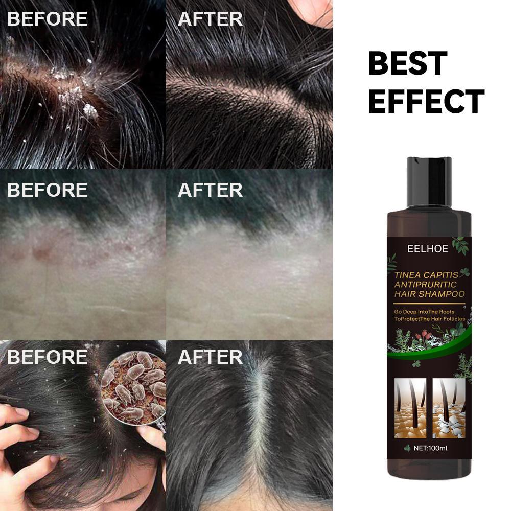 Anti-Dandruff Shampoo - Itch Relief, Hair Loss Prevention & Oil Control.