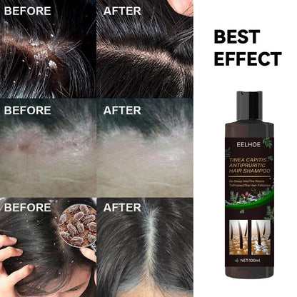 Anti-Dandruff Shampoo - Itch Relief, Hair Loss Prevention & Oil Control.